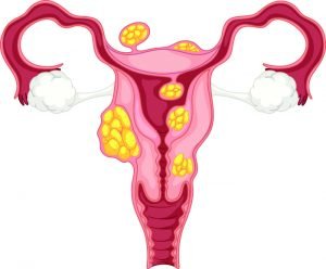 Calcified Uterine Fibroids