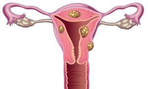 Submucosal Fibroids: Symptoms, Causes, and Treatment