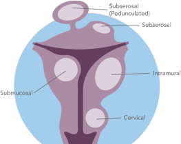Fibroid Illustration Fibroid Illustration