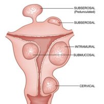 uterus fibroids