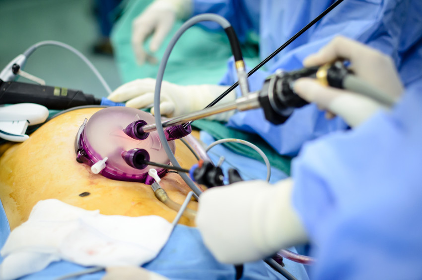 laparoscopic surgery fibroid morcellation image