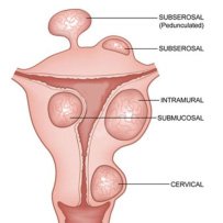 fibroid-types