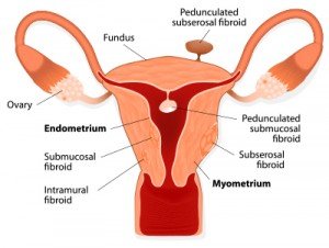 Fibroid Embolization