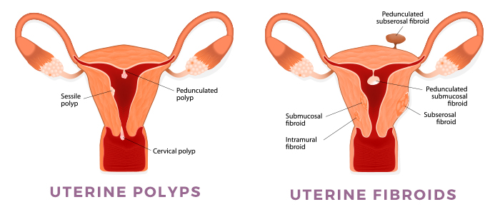 Uterine Polyps vs. fibroids