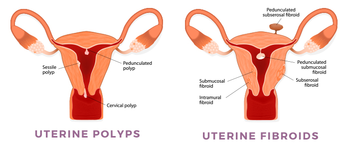 The Difference Between Fibroids And Endometriosis