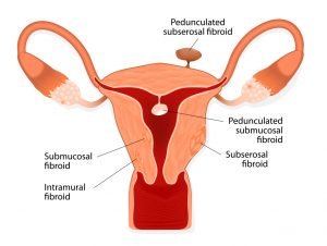 Fibroid Types