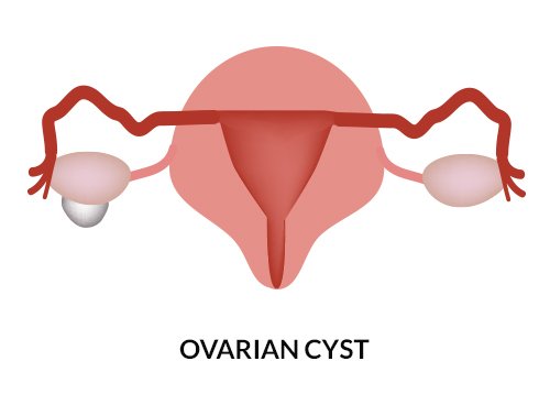 Infographuic Image of ovarian cyst