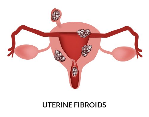 Uterine Fibroids Cause Enlarged Uterus