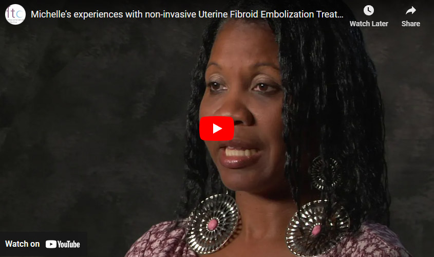 Michelle's experiences with non-invasive Uterine Fibroid Embolization Treatment