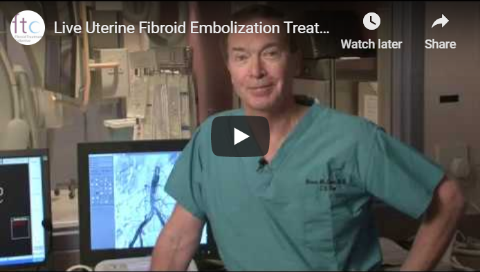 Video thumnail for Live Uterine Fibroid Embolization Treatment