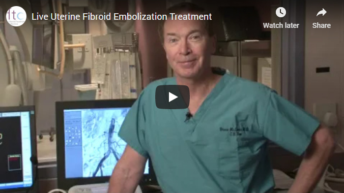 Youtube thumbnail for video Live uterine fibroid embolization treatment